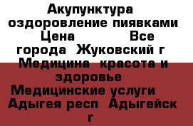 Акупунктура, оздоровление пиявками › Цена ­ 3 000 - Все города, Жуковский г. Медицина, красота и здоровье » Медицинские услуги   . Адыгея респ.,Адыгейск г.